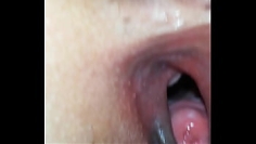 Wide cunt hysteroscopy